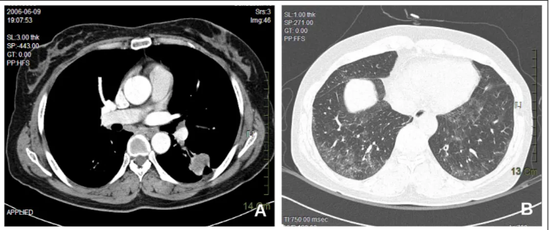 Figure 2.  (A) A 3-cm enhancing mass showing air bronchogram and speculated margin with pleural tag is noted  in the superior segment of the left lower lobe