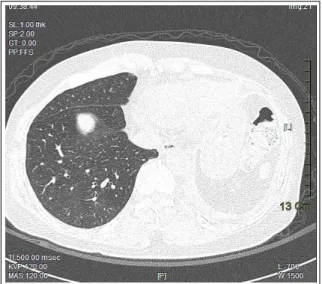 Figure  5.   There  is  left  lower  lobectomy  state,  and  previous  ground-glass  opacity  on  figure  2B  is  not  noted in the right lower lobe.