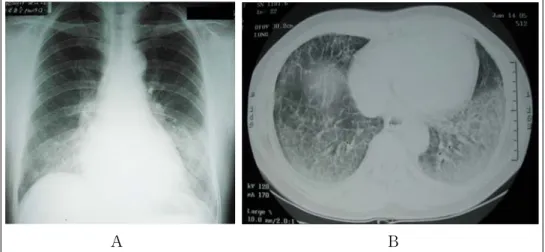 Figure 1.  (A) Chest X-ray showing diffuse, patchy and ground-glass opacities on both middle and lower lung field