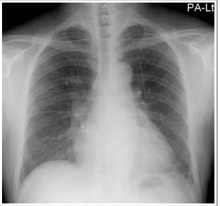 Figure 3.  Bilateral patchy and ground-glass opacities  completely resolved on a follow-up chest X-ray taken  five months after the open lung biopsy.