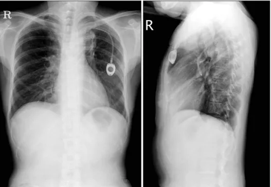 Figure 3. In a cross section, the configuration of the embolized portion  of the catheter is not circular, but instead elliptical.
