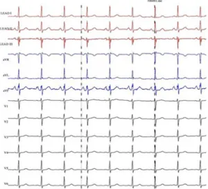 그림 2.  12-채널 ECG  신호 예