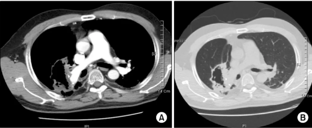 Figure  4.  Facial  CT  shows  small  fluid  density  and  thickening  of  bony  wall  in  the  right  and  left  maxillary  sinuses