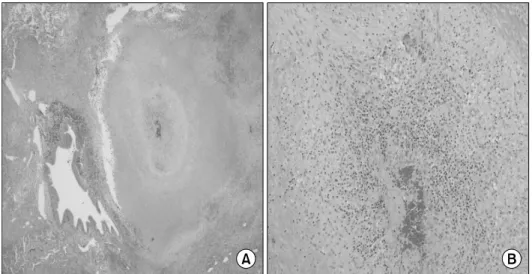 Figure 6. On microscopic examination, the granulomatous necrotizing vasculitis of large arteries and veins (A; H&amp;E stain,