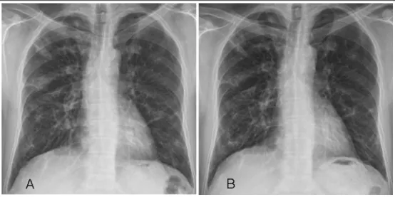 Figure 1.  Initial Chest PA shows bilateral multifocal ill-defined peripheral dominant consolidations, nodules and  reticular opacities (A)