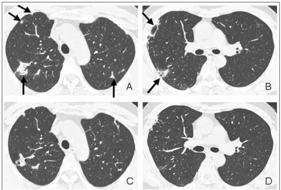 Figure 2.  Lung window of transaxial enhanced CT (1.25-mm collimation) scans done at initial diagnosis, where  aortic arch level (A) and right bronchus intermedius level (B) shows irregular shaped nodules, reticular lesions  and both upper lobe consolidati