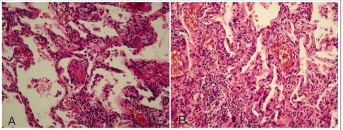 Figure 4.  Histologic findings of open lung biopsy. These microscopic findings show mild to moderate chronic  interstitial inflammation, containing lymphocytes and a few plasma cells, in a uniformed pattern