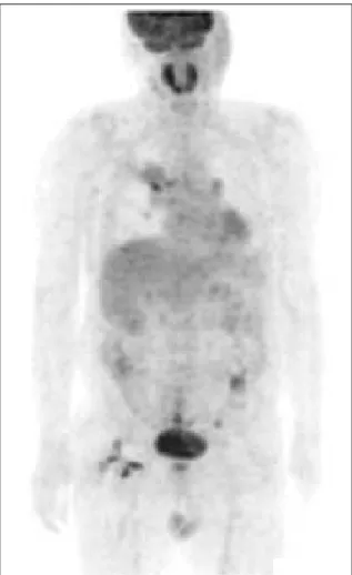 Figure  3.   Ultrasonography  of  liver  shows  an  about  1.91  cm-sized  hypoechoic  mass  with  indistinct  margin, which includes echogenic portion