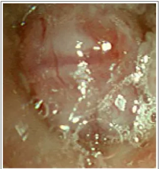 Figure 5.  Bronchoscopy shows a mass occluding the  orifice of anterior segmental bronchus of right upper  lobe