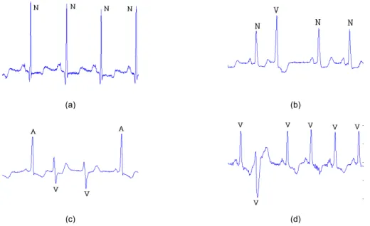 그림 3. QRS 폭의 변화(N : Normal, V : PVC, A: PAC) (a) 100(Normal) (b) 105, 116, 119(PVC) (c) 106, 114, 213,  223(PVC) (d) 200, 233(PVC)