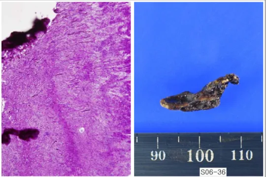 Figure 4.  Microscopy shows septated hyphae of Aspergillus with acute angulation (upper, PAS stain x400), and  gross picture shows the removed blackish stone-like material (lower).