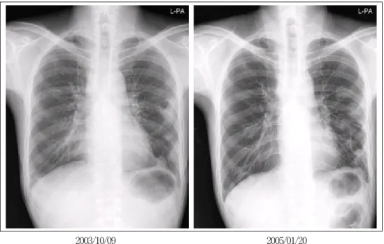 Figure 2.  At initial chest CT (A) shows multifocal consolidation with ground glass haziness and some cavitary  change in subpleural area of both lung