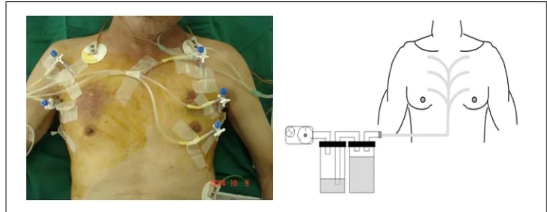 Figure 2.  High Resolution Computed Tomography of chest shows upper thorax(A) and lower thorax(B) of patient