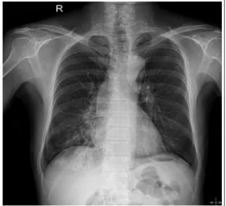 Figure 1.  Chest X-ray shows ill-defined infiltrations in  the  right lower  lobe.  Dilatation  of  trachea  and  both  bronchi are noted.