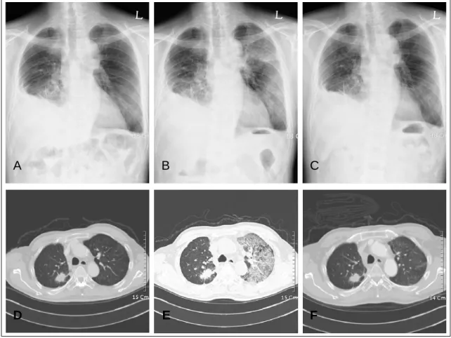 Figure 1.  In chest X-ray and chest CT, there were no differences from the lesion that were primary mass showed  that the primary malignant mass in RUL, pleural metastasis and malignant effusion in right hemithorax, and small  pleural effusion or pleural t