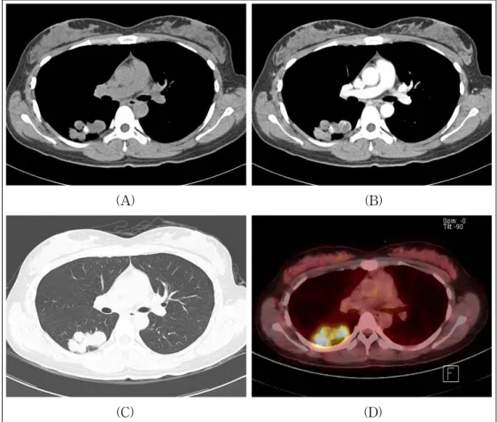 Figure 2.   Chest  CT  and  PET-CT  shows  a  lobulating  mass  with  calcification  in  the  right  lower  lobe  superior  segment(A: 