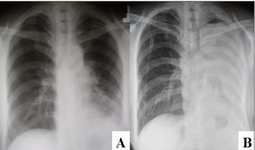 Figure  1.  Chest  PA.  (A)  Initial  film  shows  consolidation  on  left  lower  lobe
