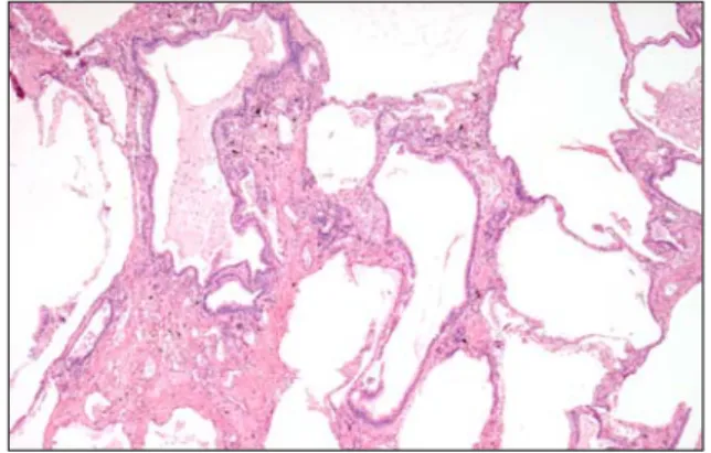 Figure  3.   Bronchoscopic  finding.  (A)  An  impacted  mass-like  lesion  covered  a  whitish  exudate  around  the  distal  main  bronchus