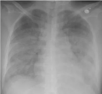 Figure  2.   Chest  CT  shows  diffuse  ground  glass  opacity  and  consolidation  with  interlobar  septal  thickening