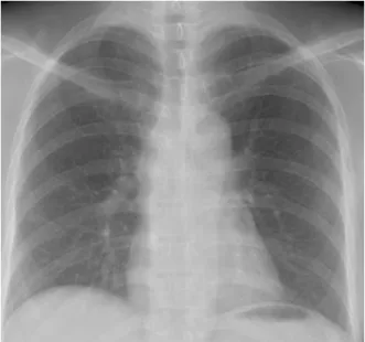Figure  5.  Chest  PA    shows  normal  finding  on  both  lung  field  after  12  momth  from  discharge.