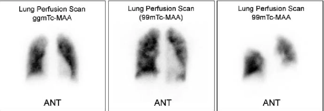 Figure  2.   Perfusion  lung  scan  findings;  normal  (left),  low  probability  (middle),  and  high  probability  (right)