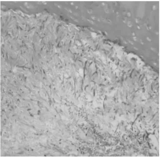 Figure  4-2. High  power  microscopy  showed  septated  fungal  organisms  with  acute  angulation,  suggesting  Aspergillus  species