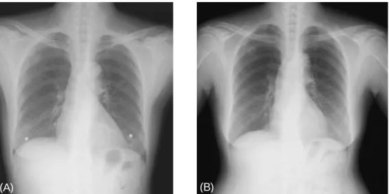 Figure  1.   Chest  PA  showed  a  round  nodule  in  right  upper  lobe  4  years  ago  (A)  and  reveals  no  interval  changes  in  solitary  pulmonary  nodule  on  admission  (B).