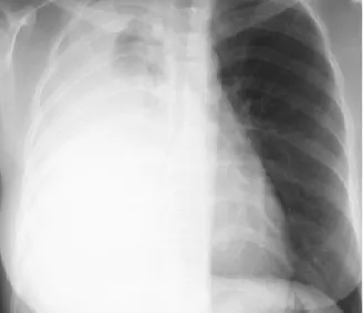 Figure  2.  3.  Initial  chest  CT  scan  demonstrates  about  2cm  sized  nodule  in  right  upper  lobe  with  ipsilateral  massive  pleural  effusion.