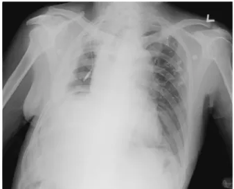 Figure 2. Contrast-enhanced  CT  scans  (A.  mediastinal  window  image,  B.  lung  window  image)  show  a  mass  containing  multiple  air  bubbles  (arrows)  in  the  dependent  portion  of  the  right  hemithorax