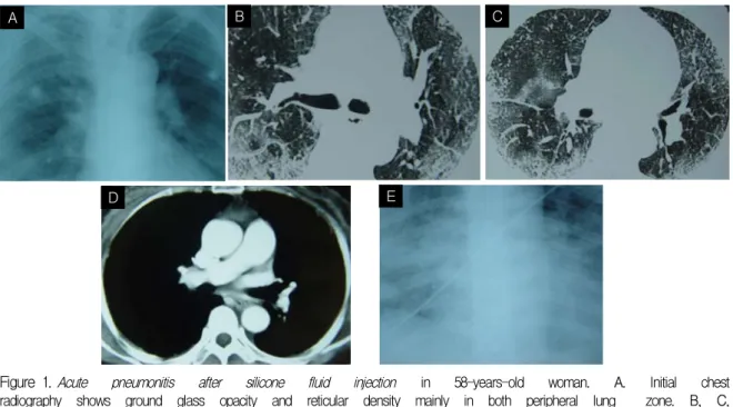 Figure 1 . Acute  pneumonitis  after  silicone  fluid  injection  in  58-years-old  woman