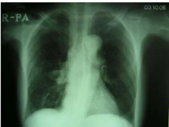 Figure 1 . Chest  PA  shows  a  ovoid  mass  in  the  right  hilar  area. □ 이달의 X-선 □증    례환    자 : 배○○,  여자,  75세.주 소 : 우연히  발견된  우측  폐종괴  검사를  위해  내원.현병력 : 자궁탈출증  수술을  위해  시행한  단순흉부사진  상  우측  폐문부에서  종괴가  발견되어  검사를  위해 입원.과거력  :  특이  소견  없음.흡연력 : 없음.진찰소견 