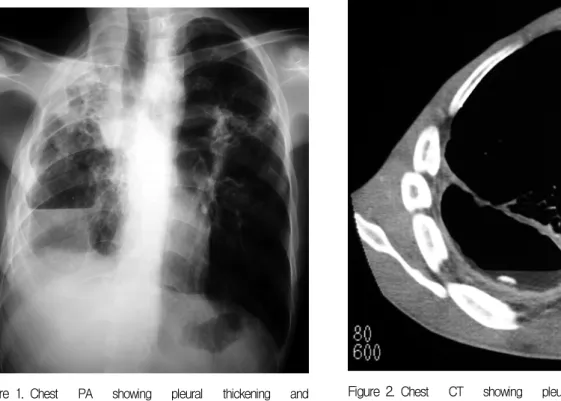 Figure 2 . Chest  CT  showing  pleural  thickening  and  air-fluid  level.검사실  소견 : 말초혈액검사는  백혈구  11,500/mm3(호중구  73.3%,  림프구  16.1%,  호산구  0.4%),  혈색소 11.0  g/dL,  혈소판  426,000/mm3였다