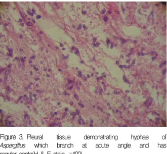 Figure 3 . Pleural  tissue  demonstrating  hyphae  of  Aspergillus  which  branch  at  acute  angle  and  has  regular  septa(H  &amp;  E  stain,  ×400).