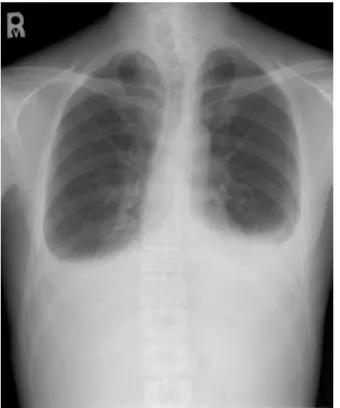 Figure 1B . Chest  PA  on  second  admission  showed  newly  developed  pneumothorax  on  right  lung.