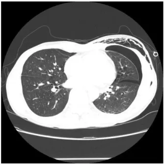 Figure 2A . Chest  computed  tomography  on  first  admission  showed  bilateral  pleural  effusions,  passive  collapse  of  base  of  right  lower  lobe,  and  ground  glass  opacities  in  left  lower  lobe  with  patent  segmental  bronchi.