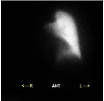 Figure 3A . Ventilation  scan  :  Ventilation  scan  showed 