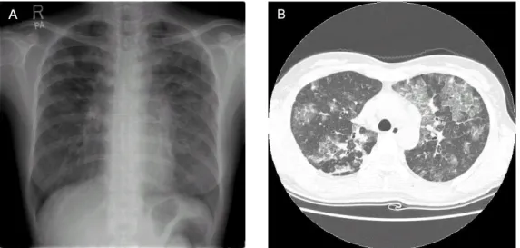 Fig. 2. Increased interstitial marking on chest X-ray is shown at hospital day 2.