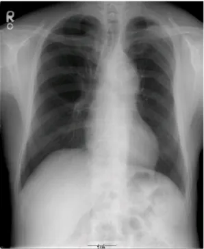 Fig. 2a. Chest CT scan showed multiple low-attenuated foci at periaortic area on admission.