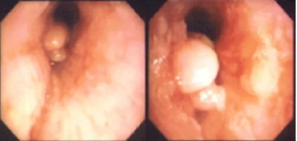 Fig. 4. Aortogram showed about 3cm sized sac cular aneurysm at the lower aspect of proximal margin of previous stent graft.