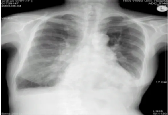 Fig. 1. Hyperinflation, blurring of pulmonary va scularity, and peribronchial infiltration in both lower lung field.