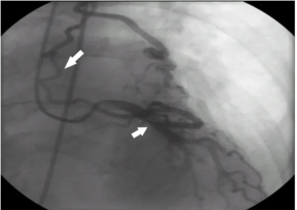 Fig. 3. Repaired fistula with transcatheter emboli zation using metallic coil (arrow).