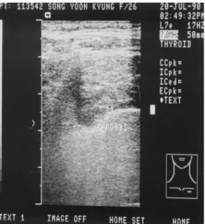 Fig. 3. Percutaneous Doppler sonography shows partial intraluminal echogenicity in the walls of both proximal subclavian veins.