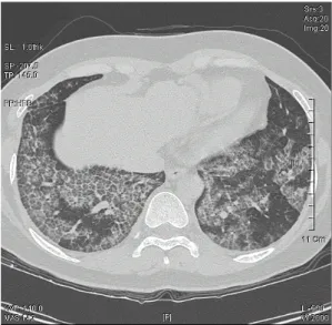 Fig. 2. Chest HRCT Shows ground glass attenu ation with interlobular septal thickening, a pattern commonly characterized as “crazy paving”.