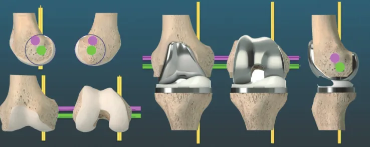 Fig. 2. From the upper margin, distal one-third to metaphyseal flare of  the femur was registered with points by pen, which made a truncated  cone