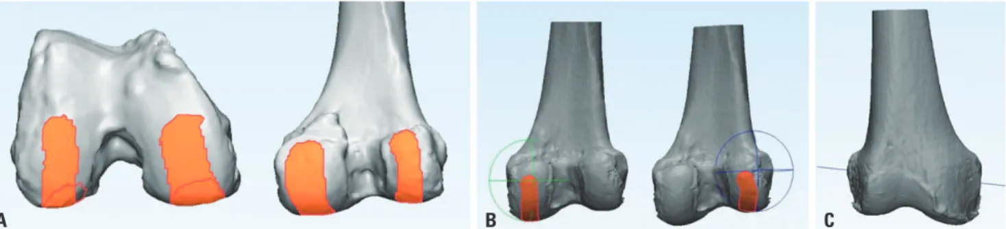Fig. 4. Preoperative determination of tibial alignment. (A) The registration process involved a surface centroid excluding regional bone defect and tibi- tibi-al spines