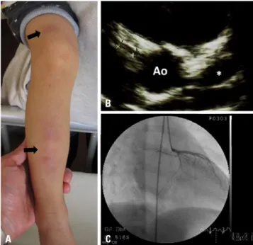 Fig. 1. Patient's cutaneous manifestations upon admission and findings of  the coronary artery lesion