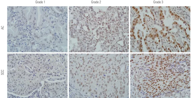 Table 1. Relationships among PRCC Expression and Clinicopathological  Variables in 161 Non-Small Cell Lung Cancers
