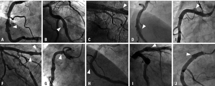 Table 2. Clinical Characteristics between Patients with and without  CAAs after Second-Generation Drug-Eluting Stent Implantation