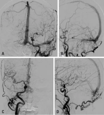 Fig. 1. Initial angiogram. (A and B) Anterior (A) and lateral (B) images of  the left CCA angiogram show dural arteriovenous fistula with retrograde  flow and cortical venous reflux (Cognard classification IIa+b)