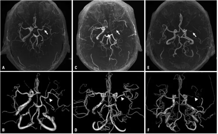 Fig. 1. Categorized 3 groups corresponding to their visualization on TOF-MRA (A, C, and E) and CTA (B, D, and F) are shown